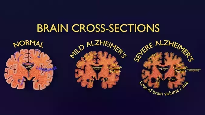 Alzheimer Disease Brain coronal slice 3D model