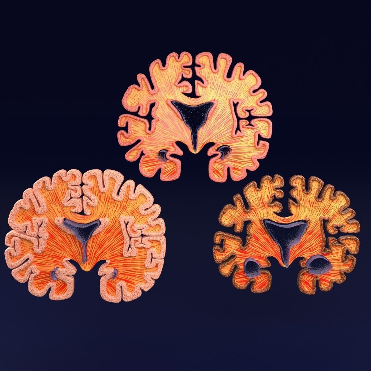 Alzheimer Disease Brain coronal slice 3D model_48