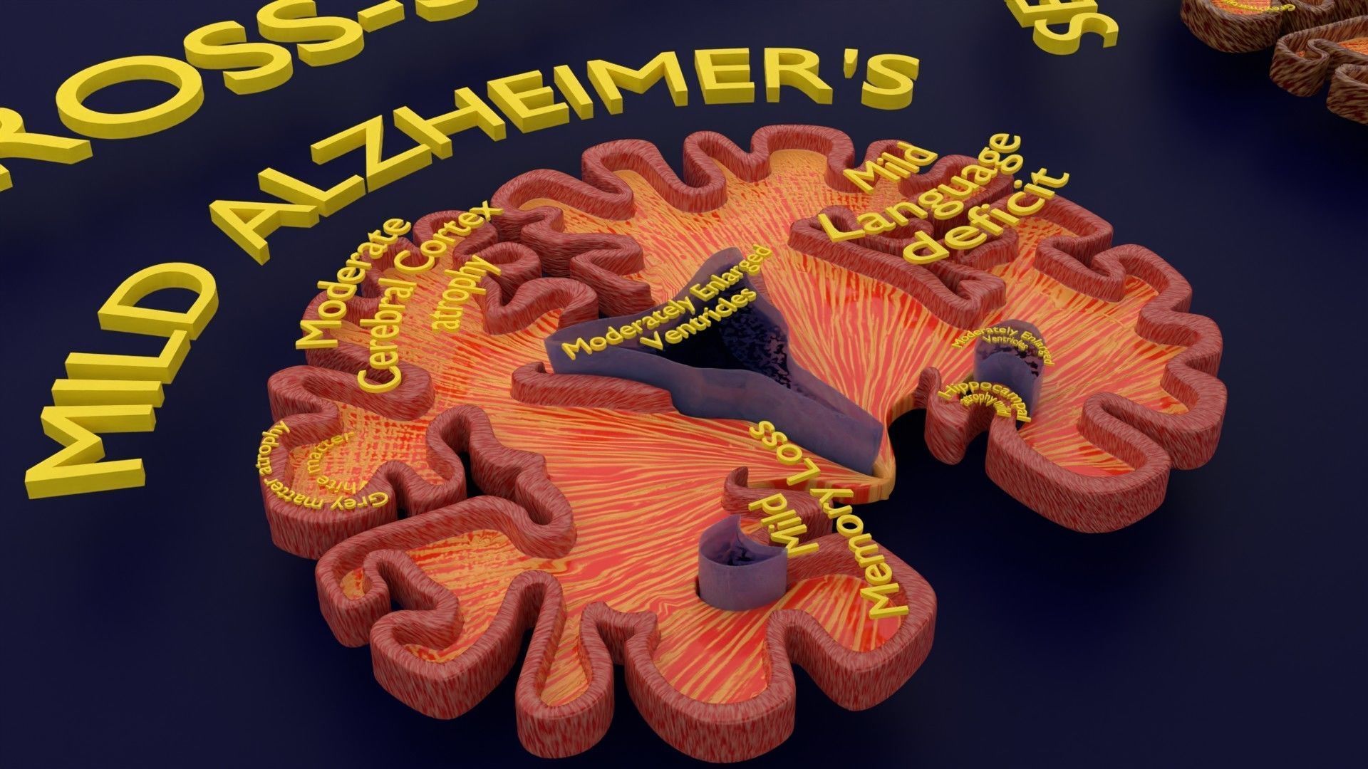 Alzheimer Disease Brain coronal slice 3D model_47