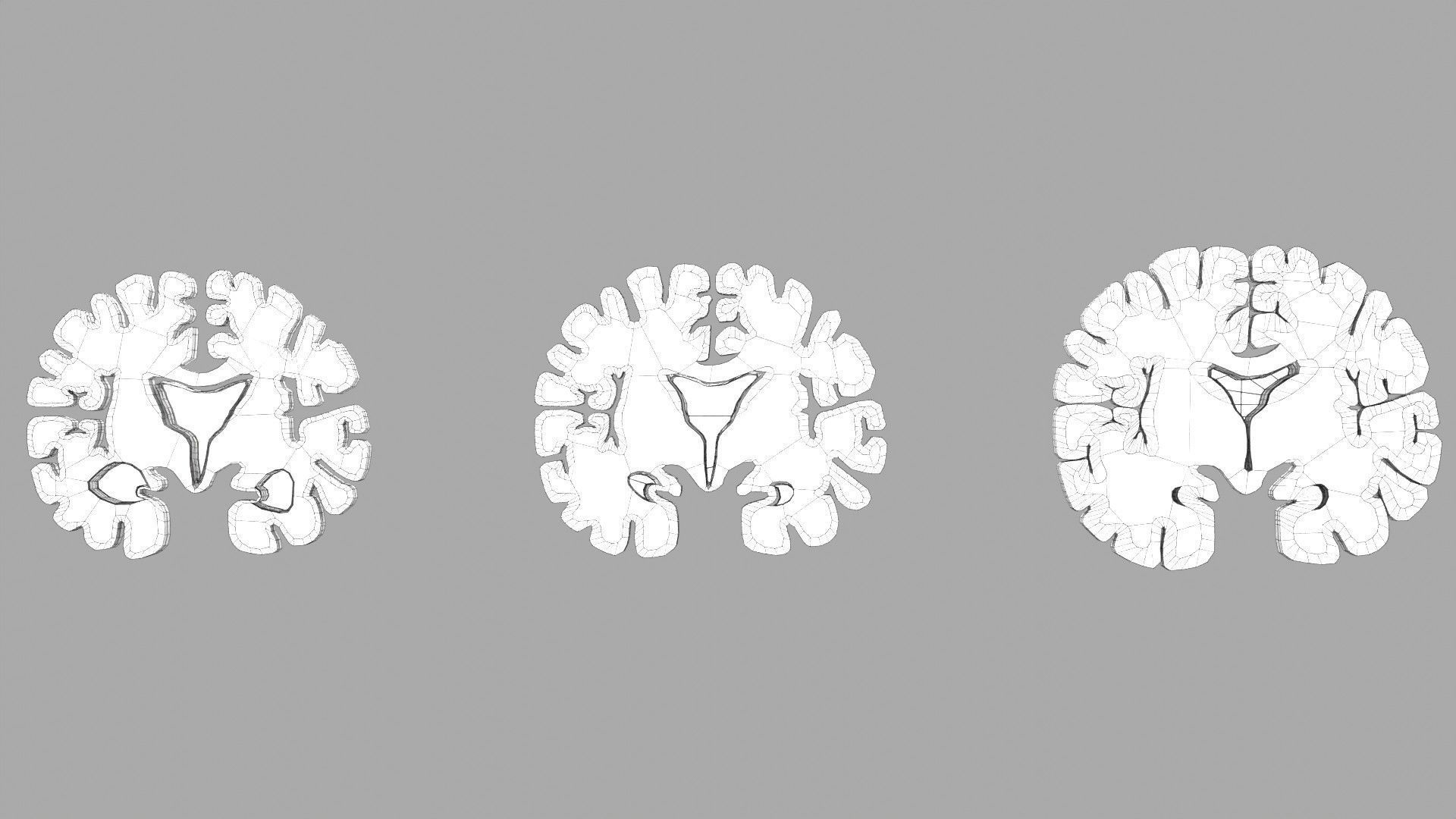 Alzheimer Disease Brain coronal slice 3D model_57