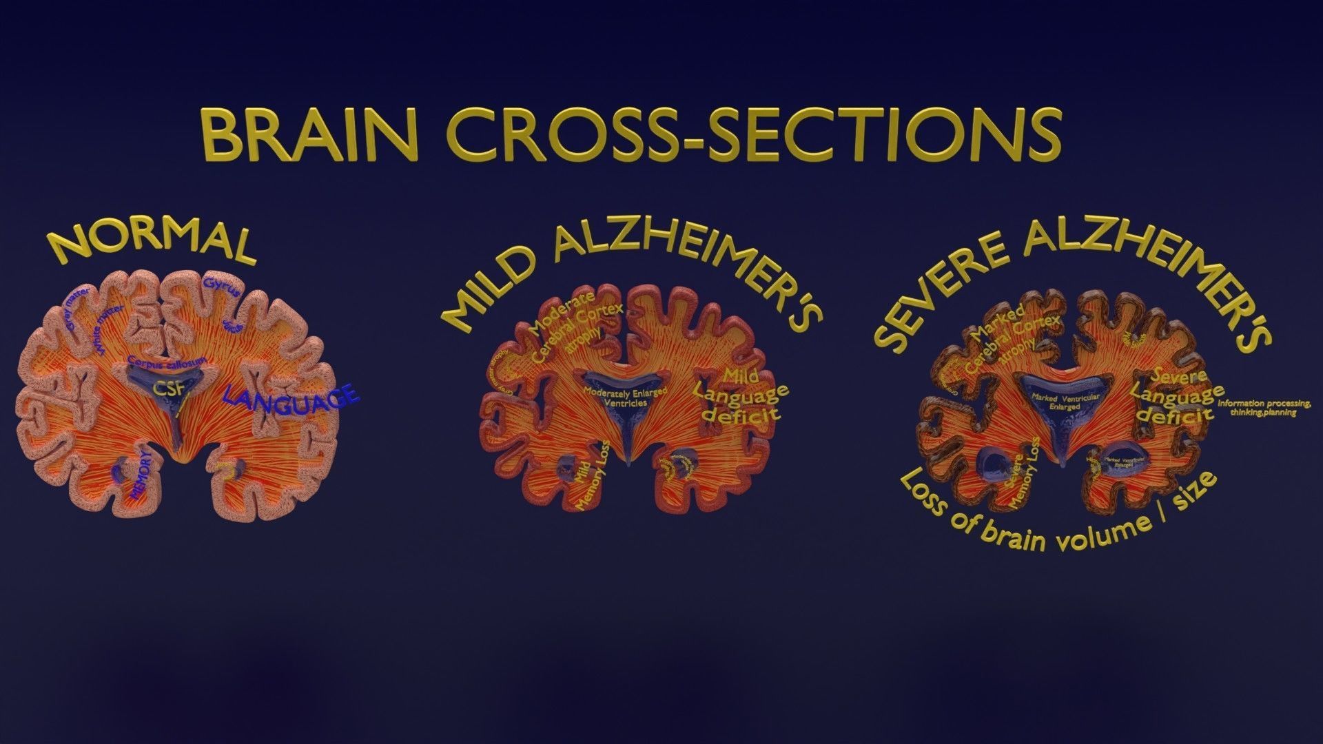 Alzheimer Disease Brain coronal slice 3D model_9