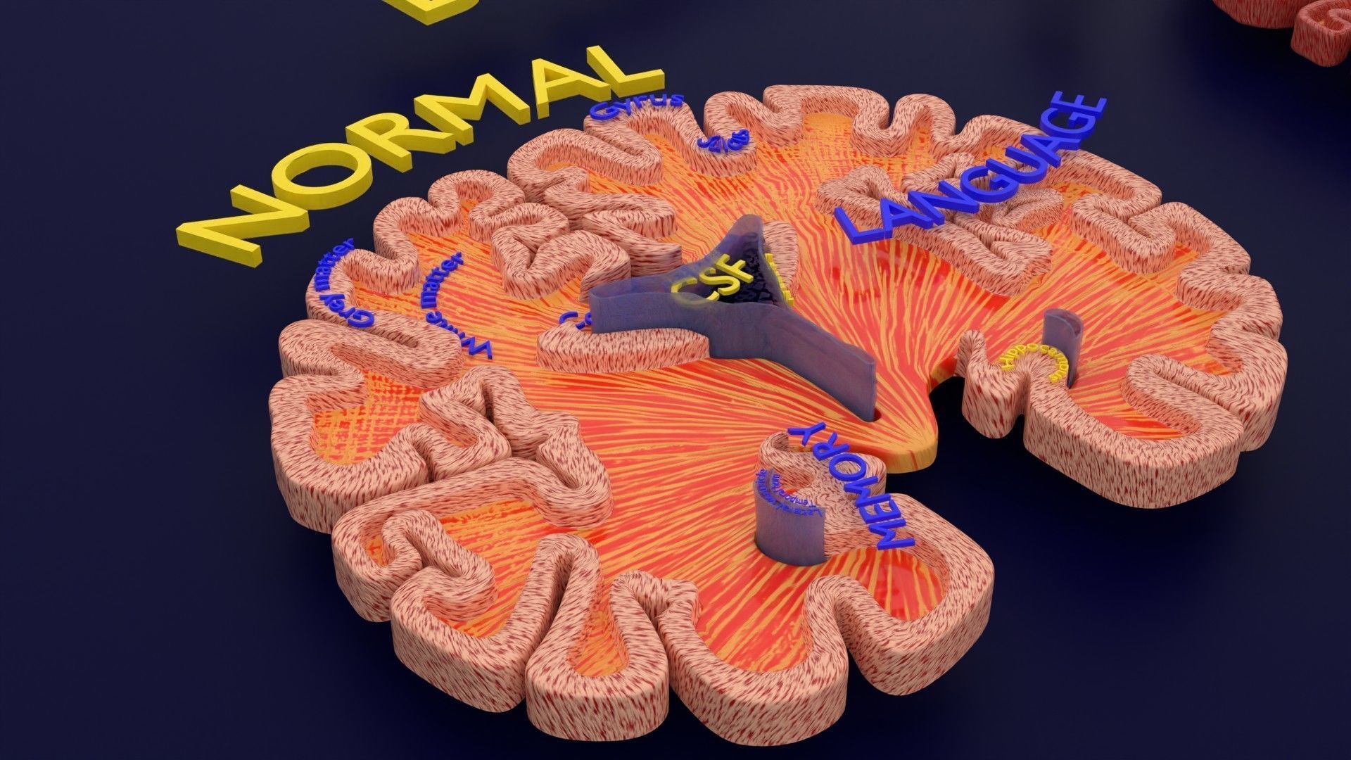 Alzheimer Disease Brain coronal slice 3D model_46