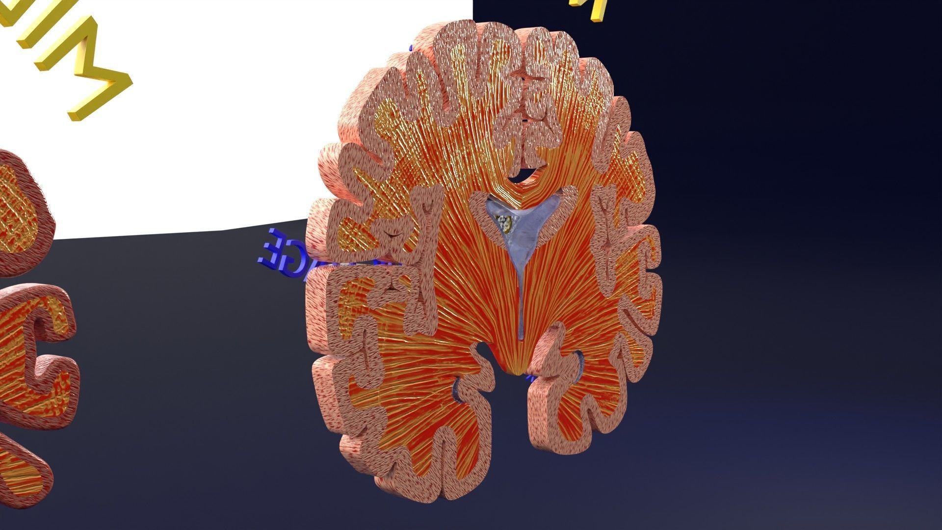 Alzheimer Disease Brain coronal slice 3D model_24