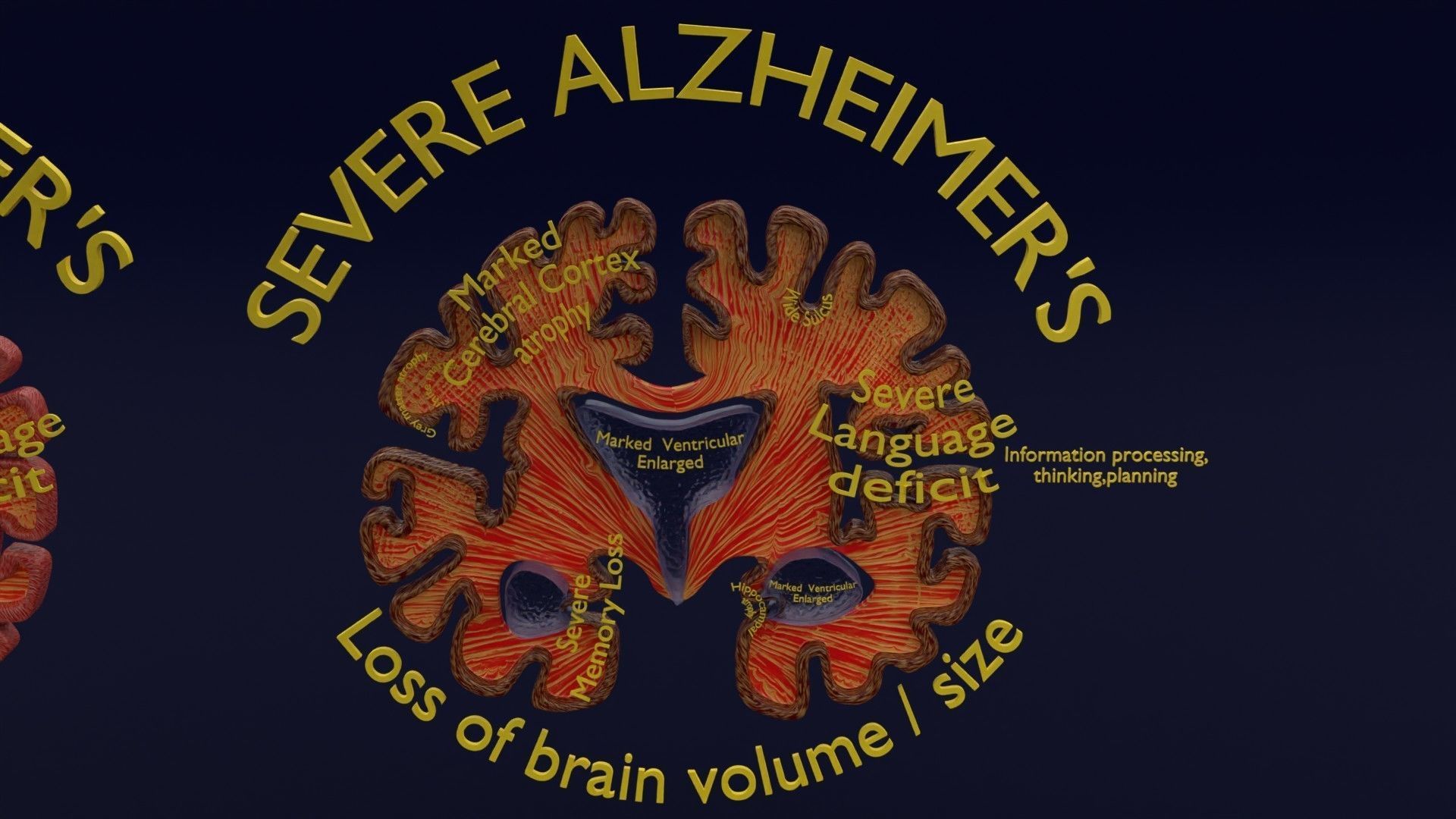 Alzheimer Disease Brain coronal slice 3D model_15