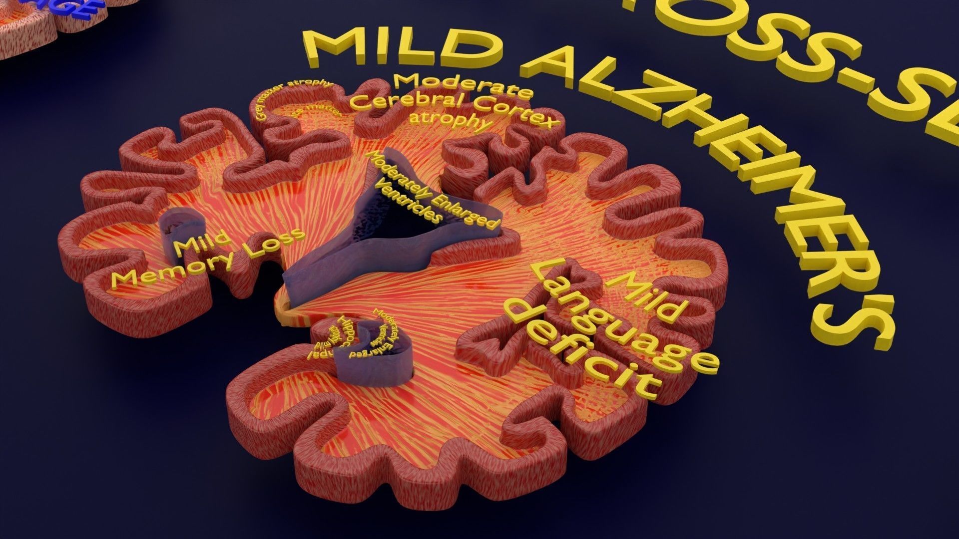 Alzheimer Disease Brain coronal slice 3D model_44