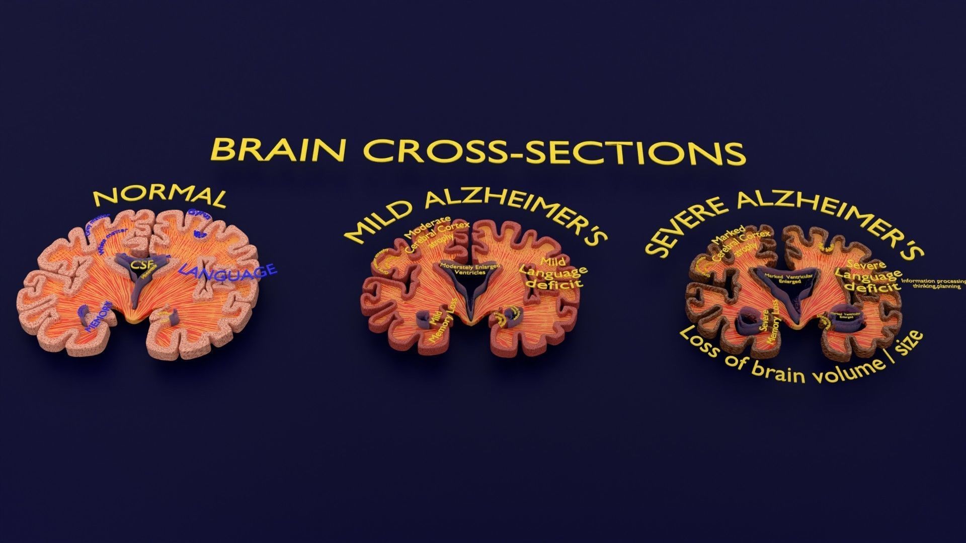 Alzheimer Disease Brain coronal slice 3D model_11
