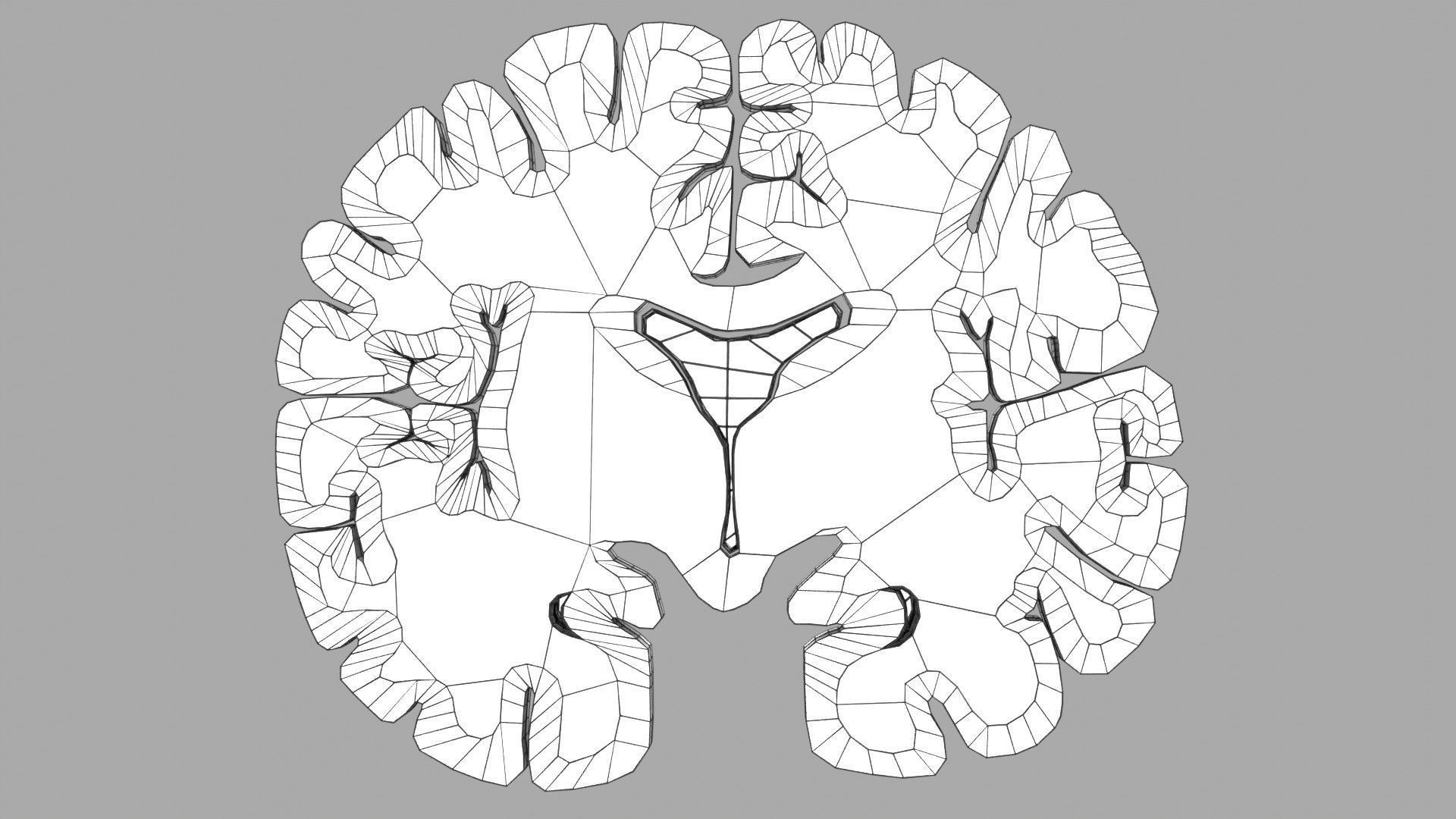 Alzheimer Disease Brain coronal slice 3D model_58