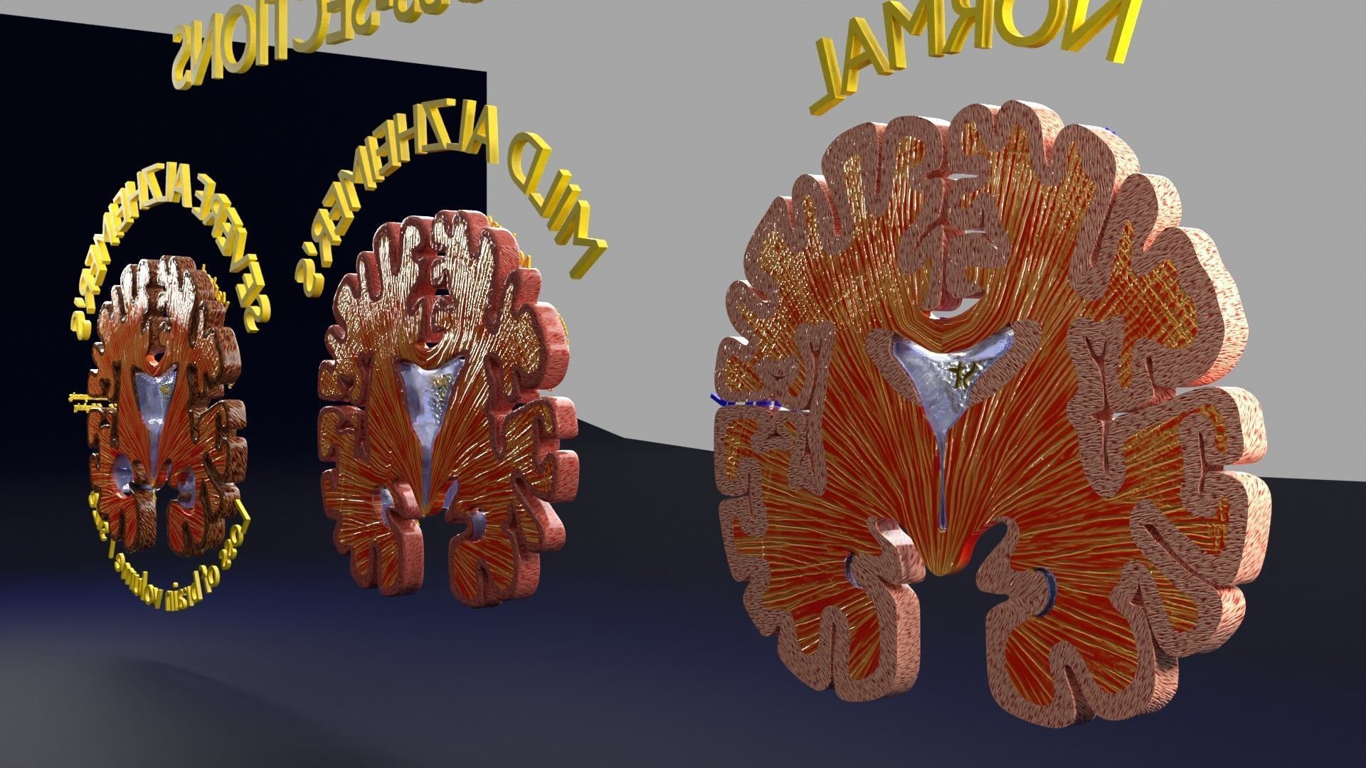 Alzheimer Disease Brain coronal slice 3D model_36