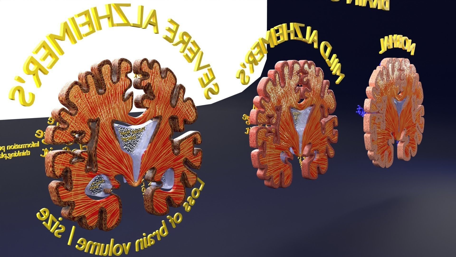 Alzheimer Disease Brain coronal slice 3D model_21