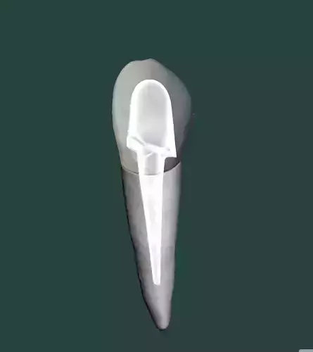 Canine root  post  core and crown 3D print model