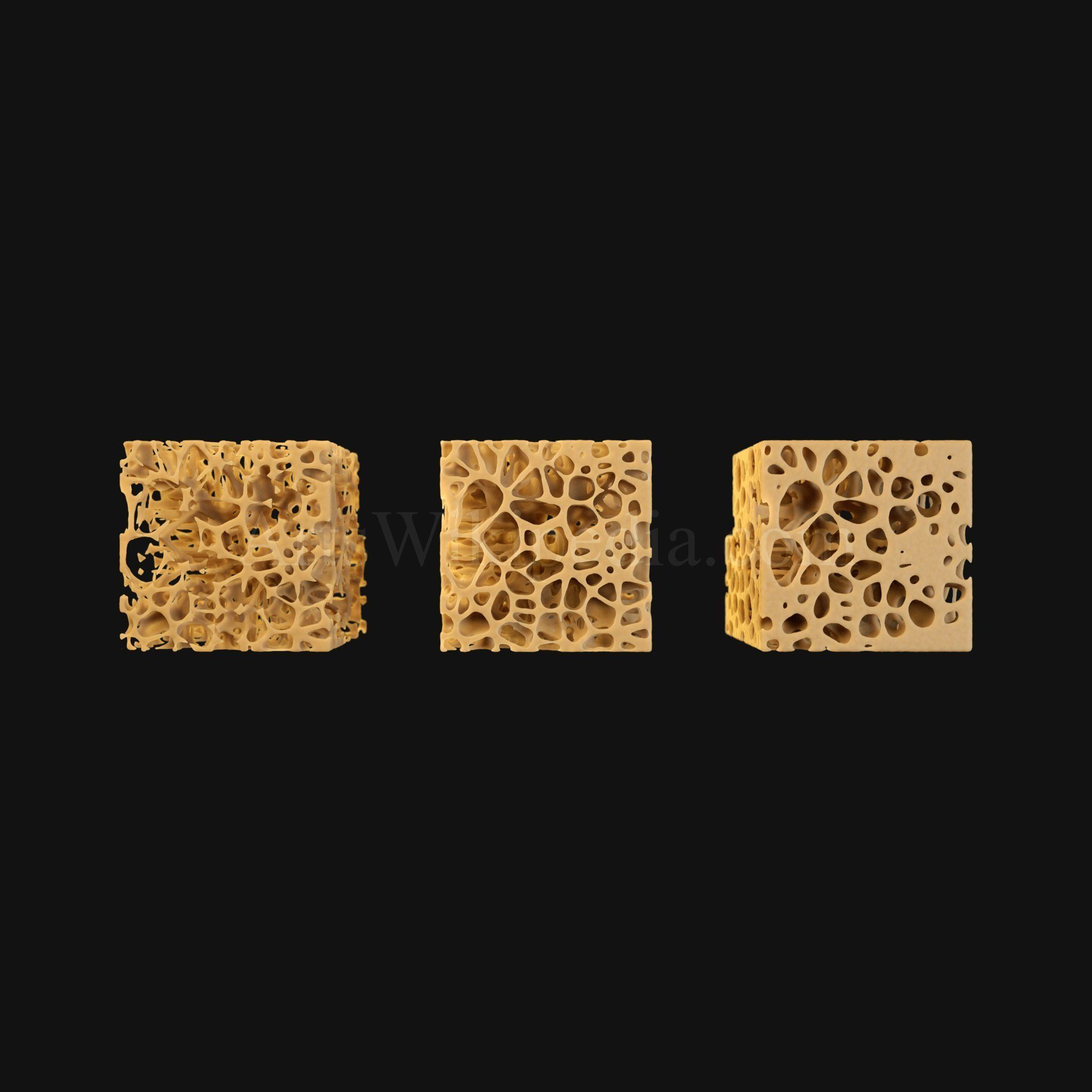 3D Normal vs Osteopenia vs Osteoporosis 3D model_6