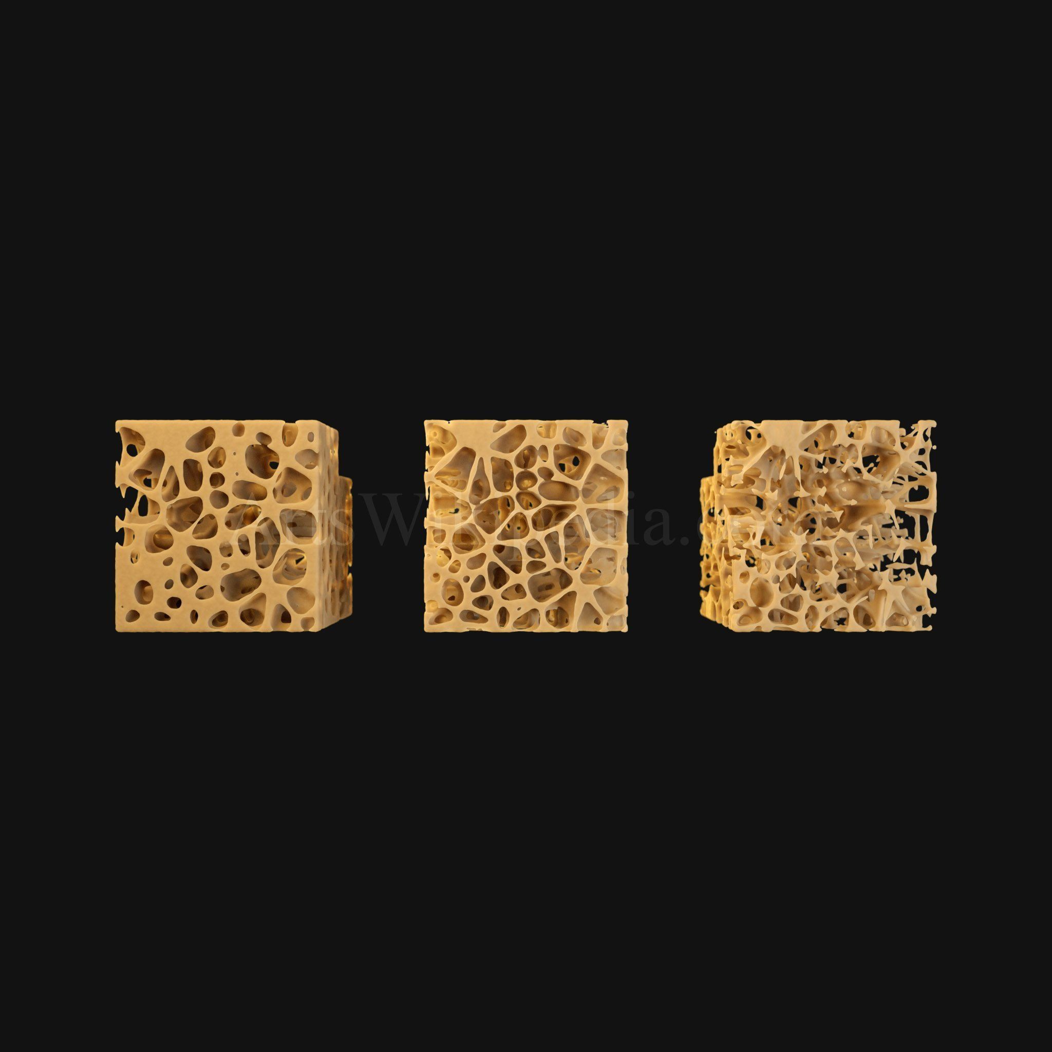 3D Normal vs Osteopenia vs Osteoporosis 3D model_5
