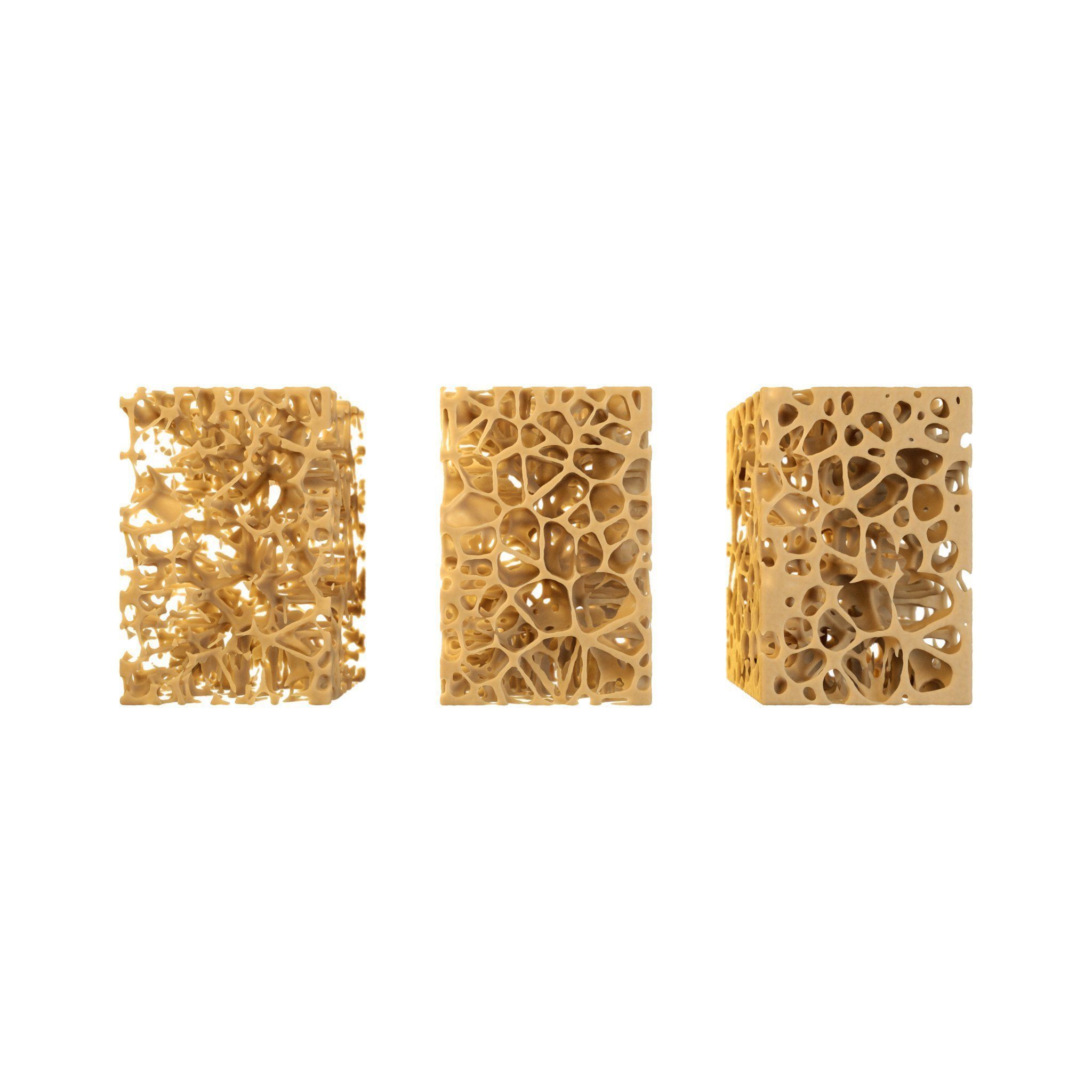 3D Spongy Bone Normal vs Osteopenia vs Osteoporosis 3D model_3