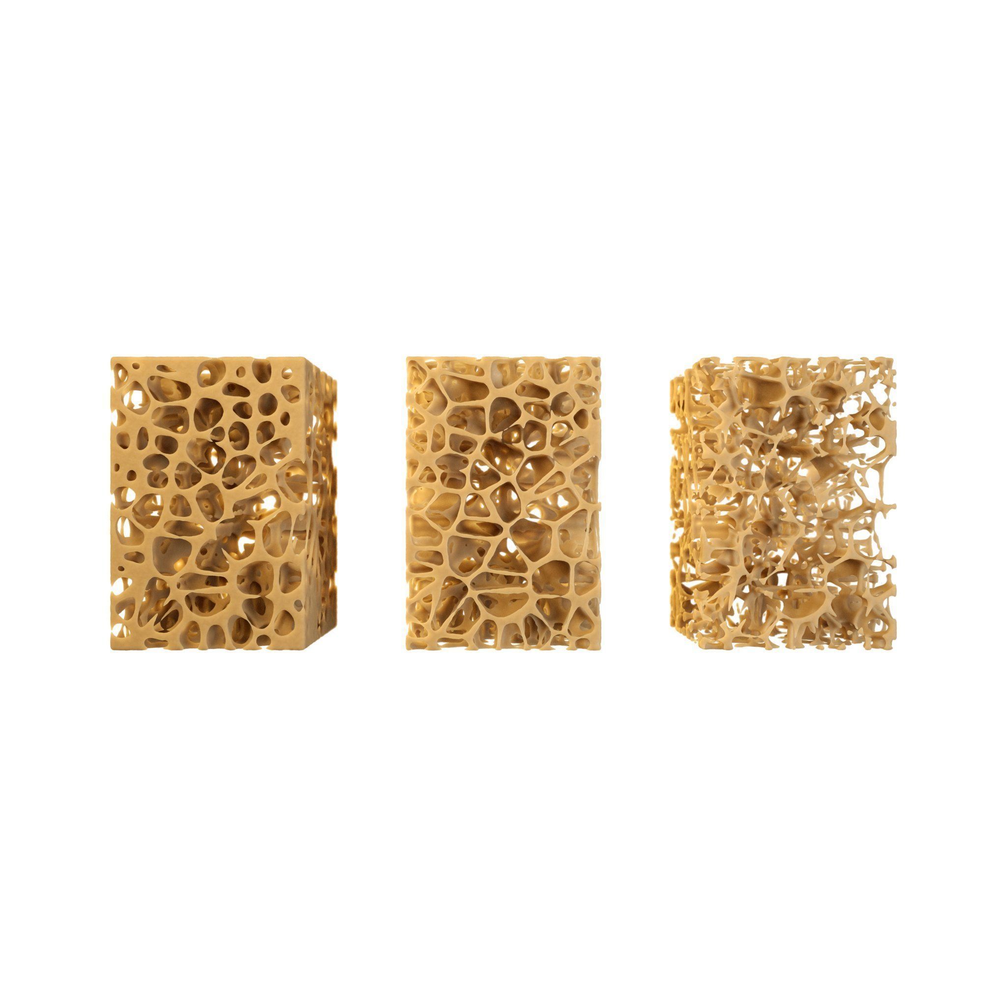 3D Spongy Bone Normal vs Osteopenia vs Osteoporosis 3D model_6