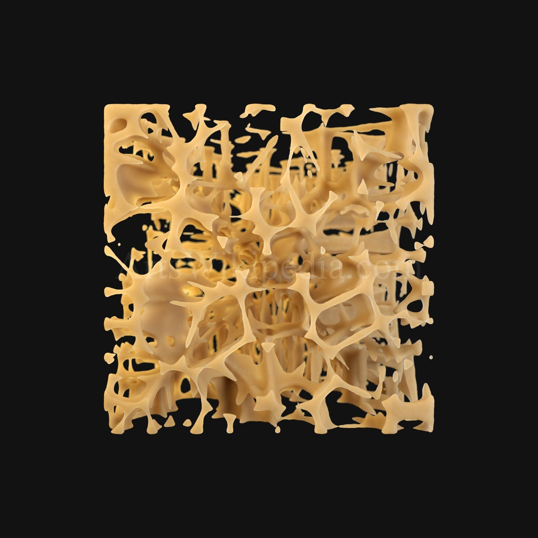 3D Osteoporosis Histology of Spongy Bone Structure 3D model_4