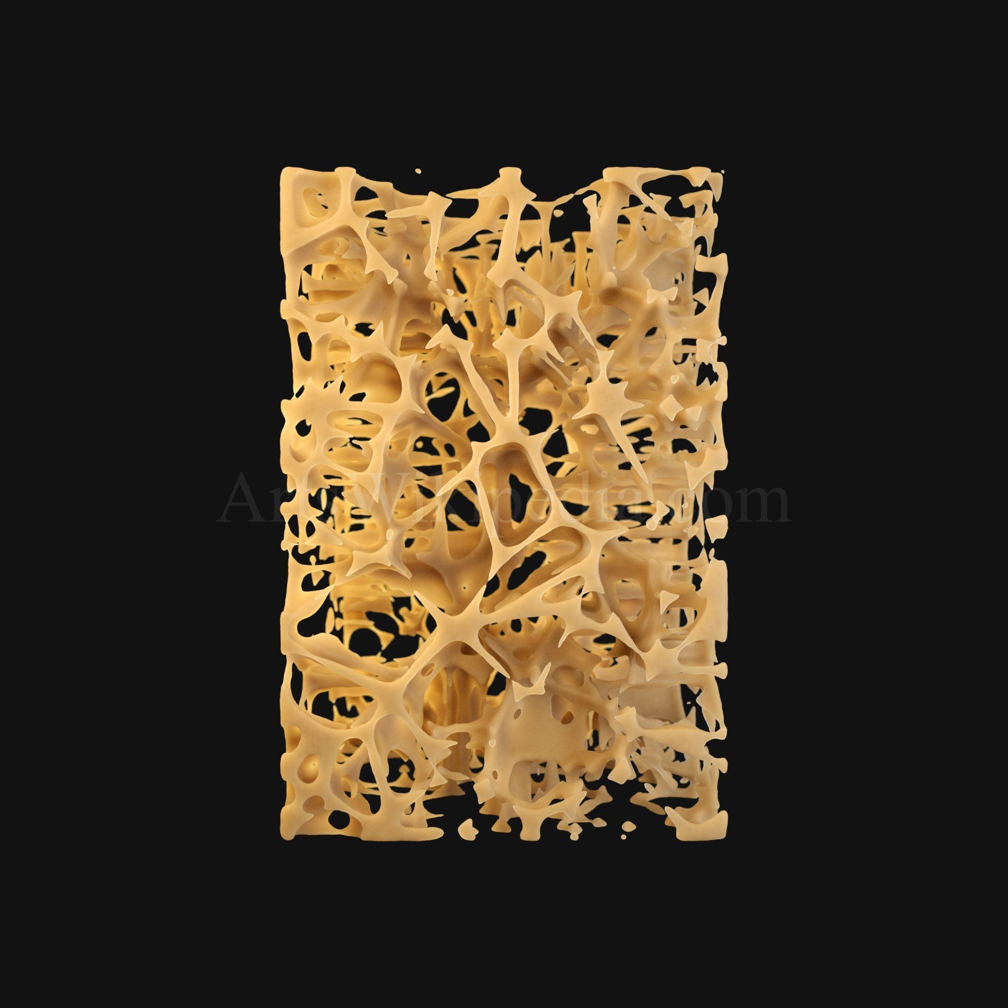3D Osteoporosis Histology of Spongy Bone Structure 3D model_3