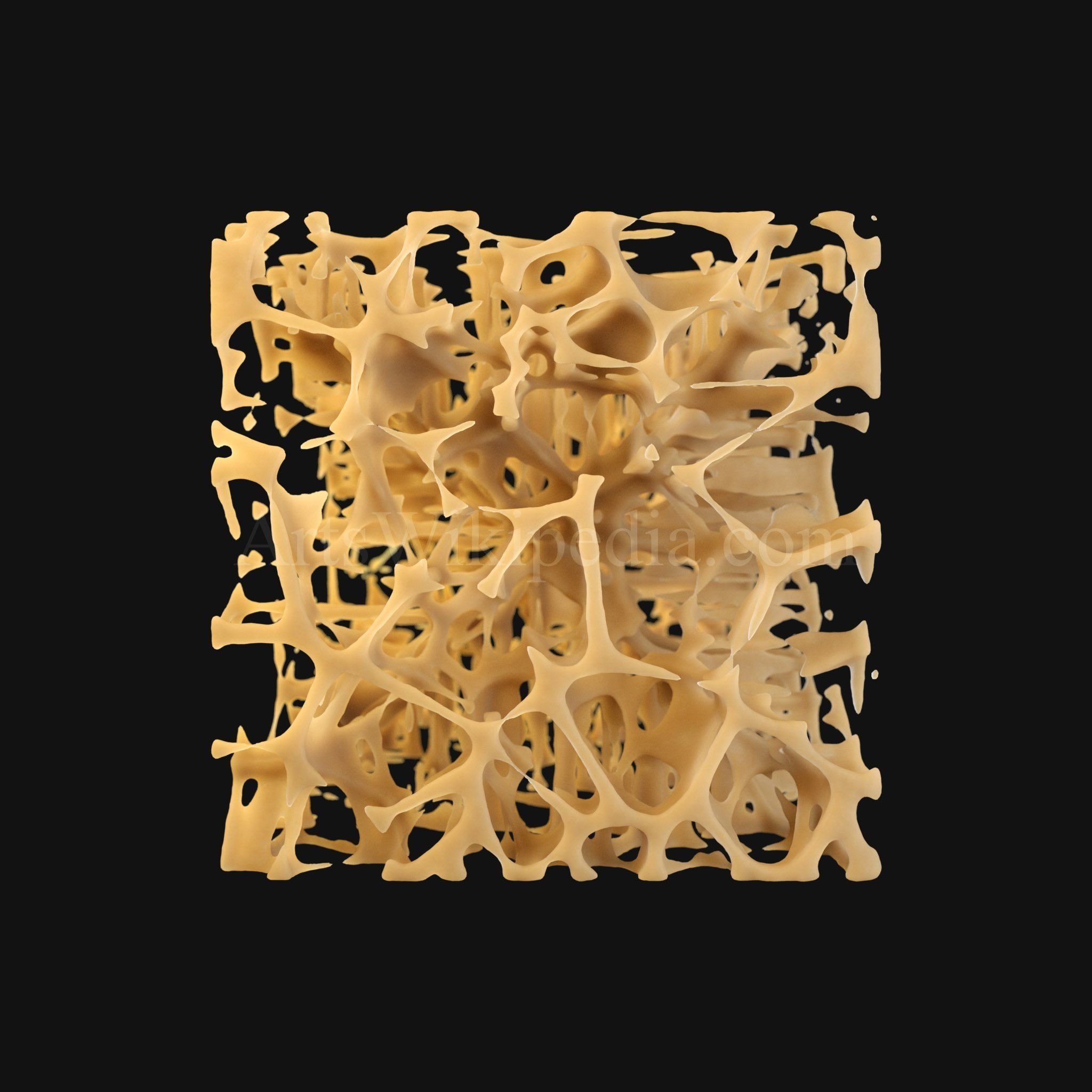3D Osteoporosis Histology of Spongy Bone Structure 3D model_1