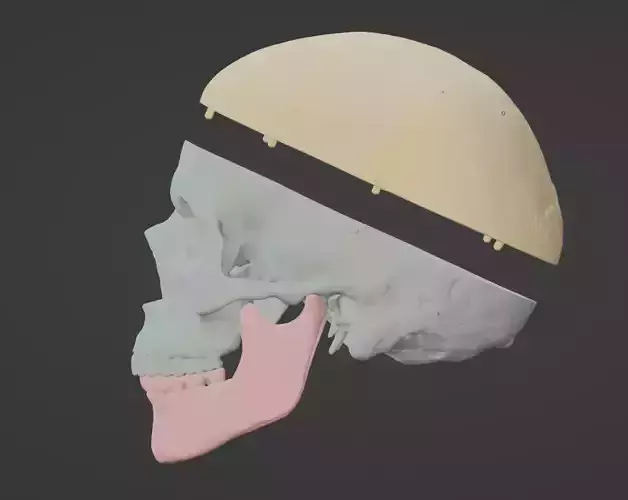 3D Model of Skull with Skull Cap and Mandible