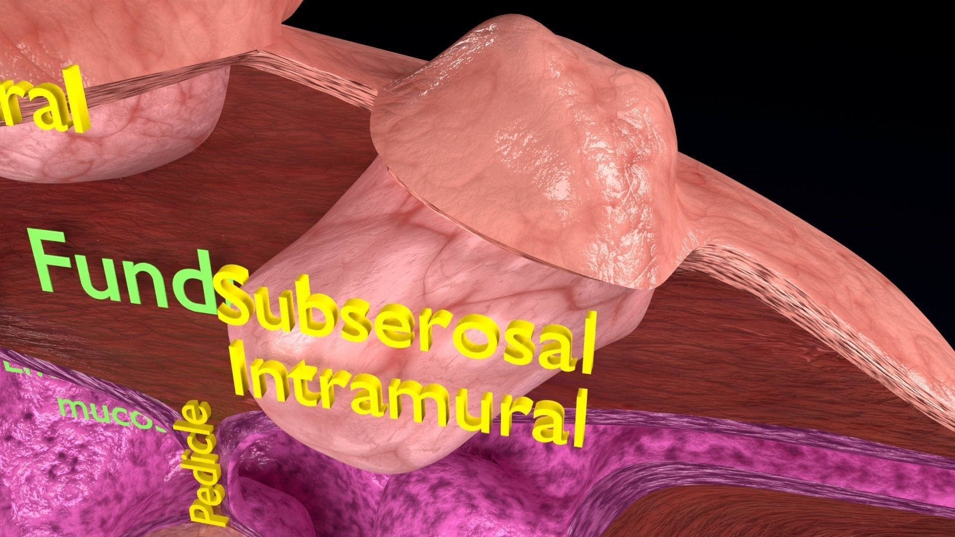 Fibroid Uterus Human female 3D Low-poly 3D model_12