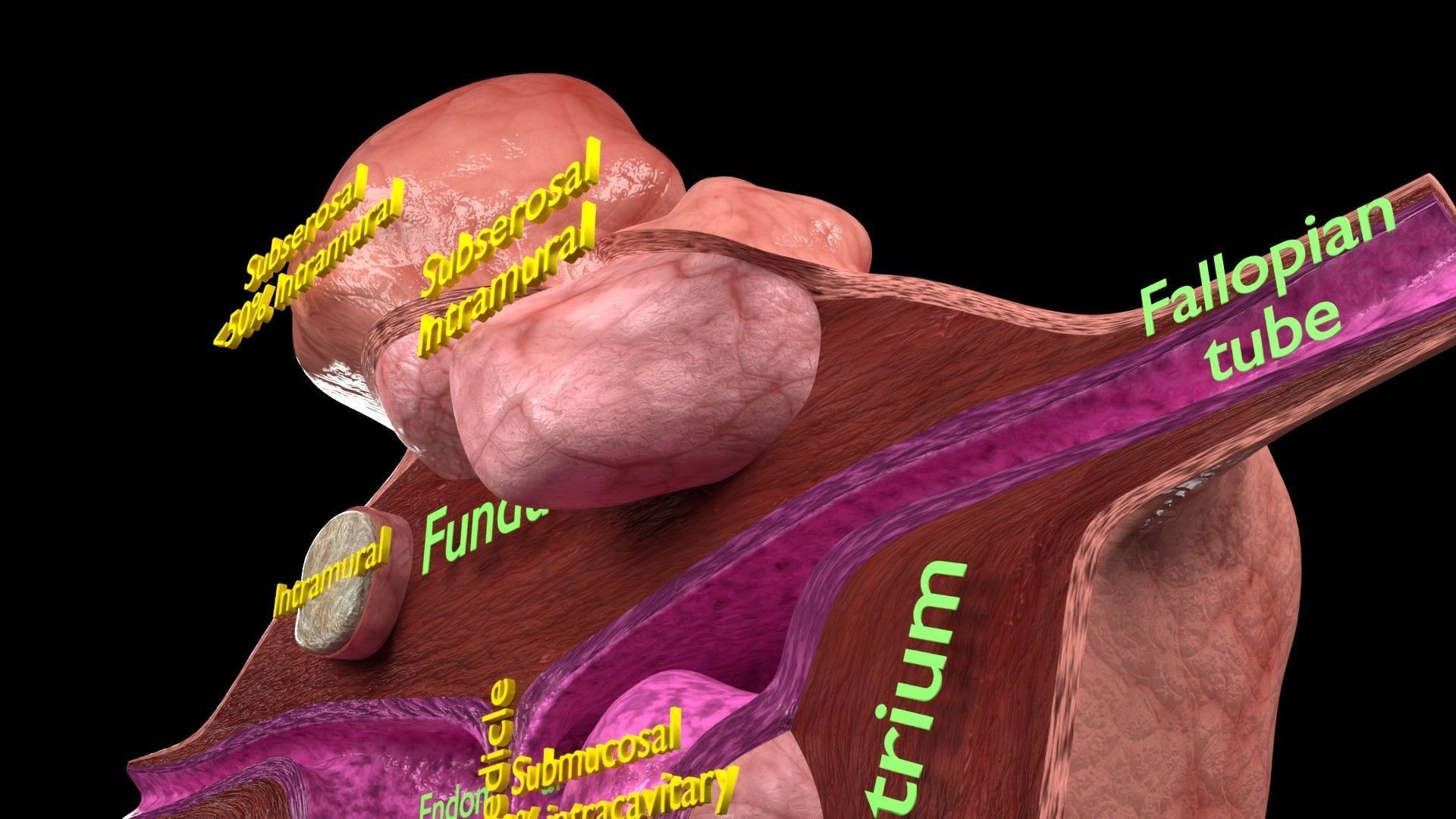Fibroid Uterus Human female 3D Low-poly 3D model_10