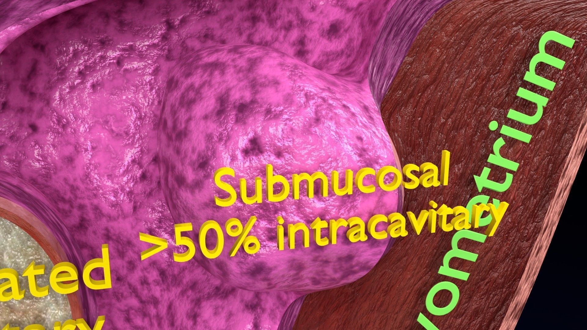 Fibroid Uterus Human female 3D Low-poly 3D model_8