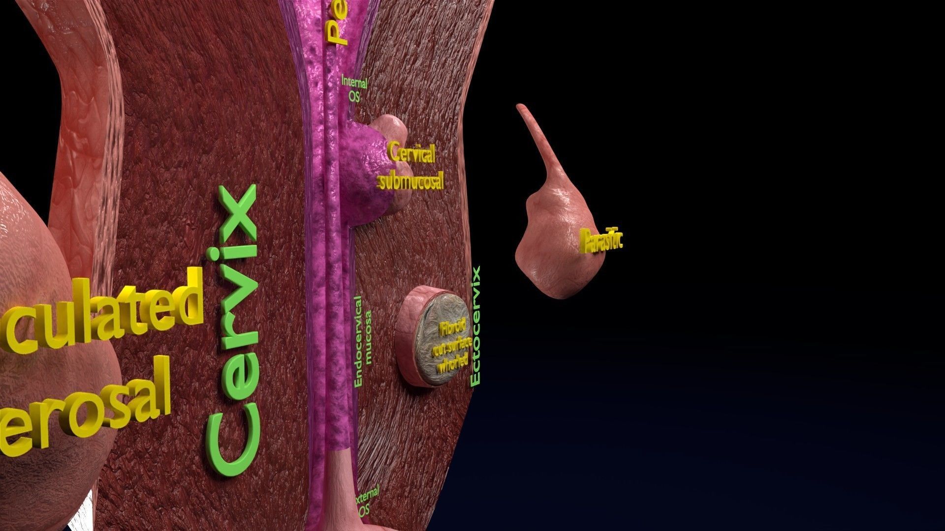 Fibroid Uterus Human female 3D Low-poly 3D model_31