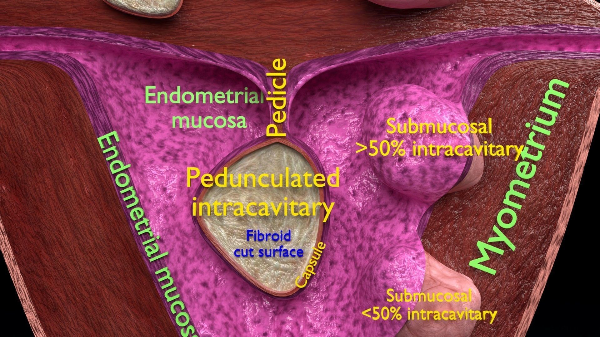 Fibroid Uterus Human female 3D Low-poly 3D model_1