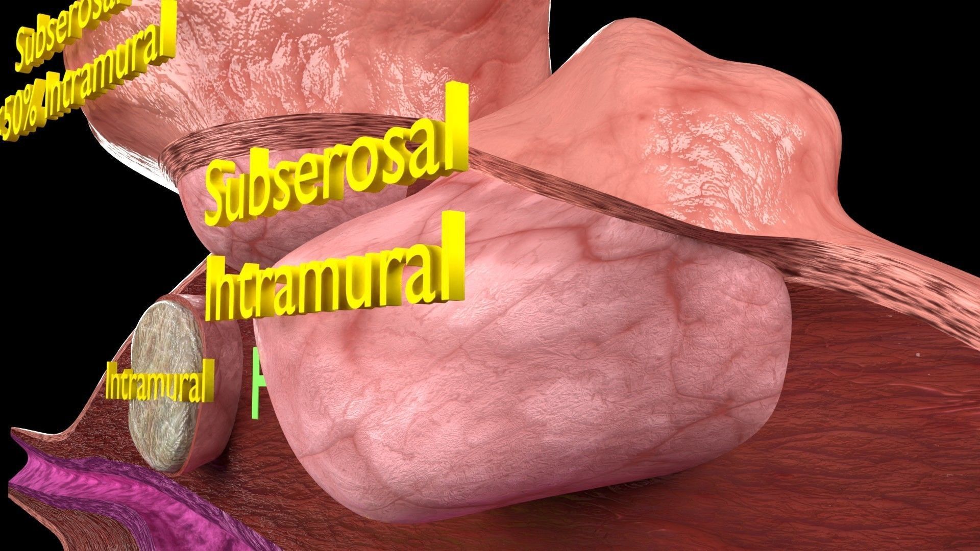 Fibroid Uterus Human female 3D Low-poly 3D model_11