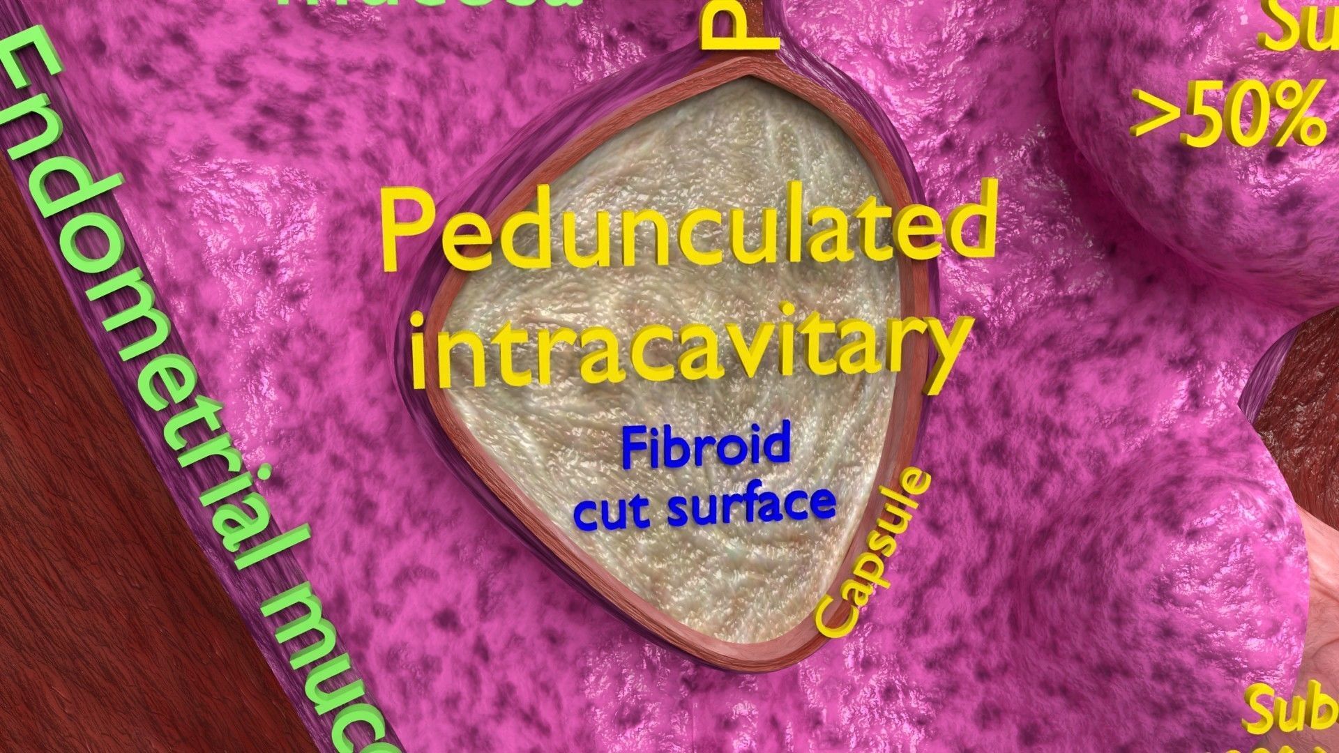 Fibroid Uterus Human female 3D Low-poly 3D model_5