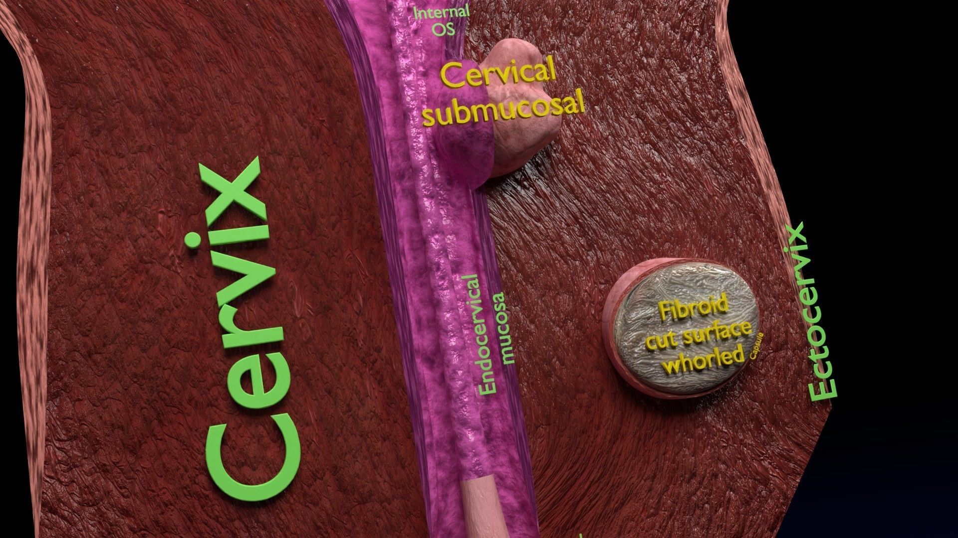 Fibroid Uterus Human female 3D Low-poly 3D model_24