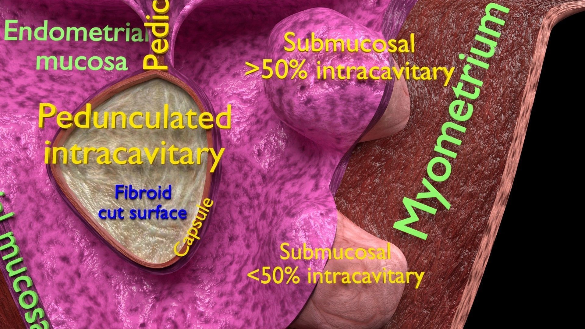 Fibroid Uterus Human female 3D Low-poly 3D model_7