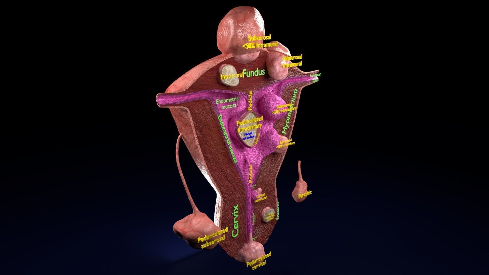 Fibroid Uterus Human female 3D Low-poly 3D model_23