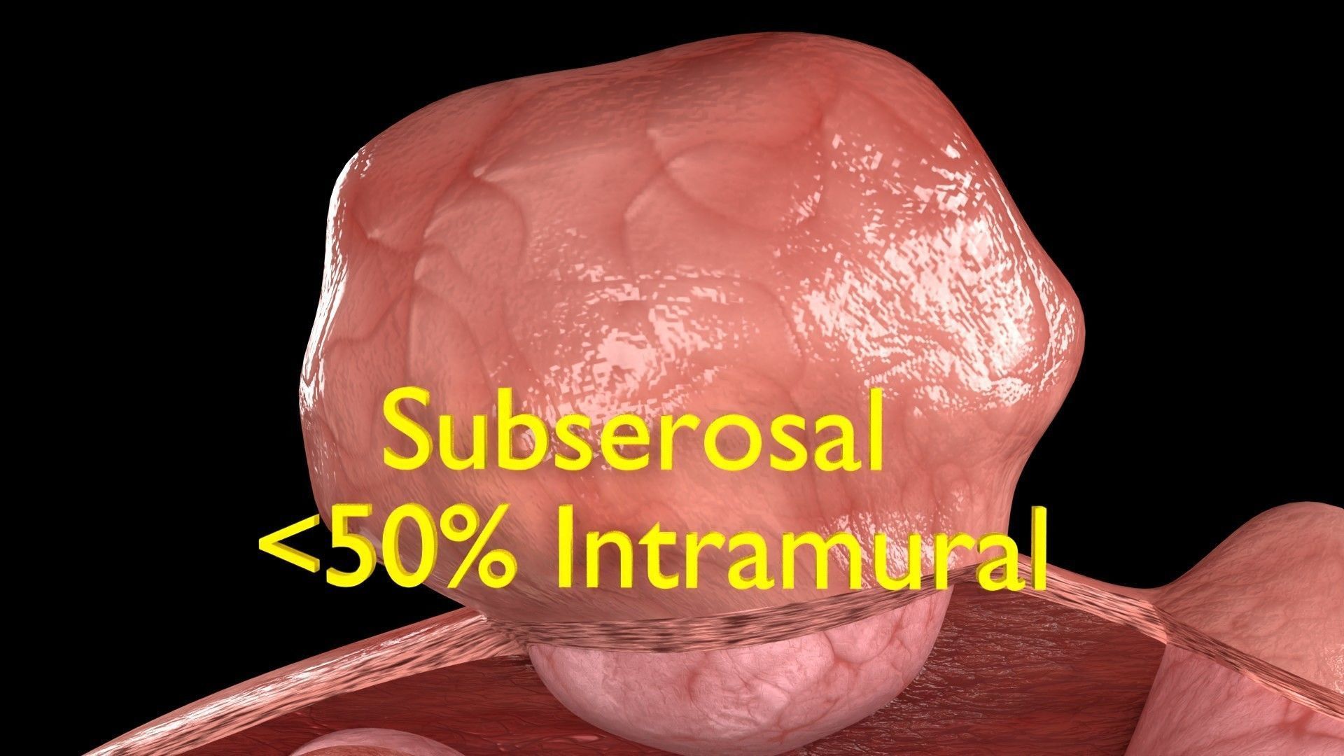 Fibroid Uterus Human female 3D Low-poly 3D model_14