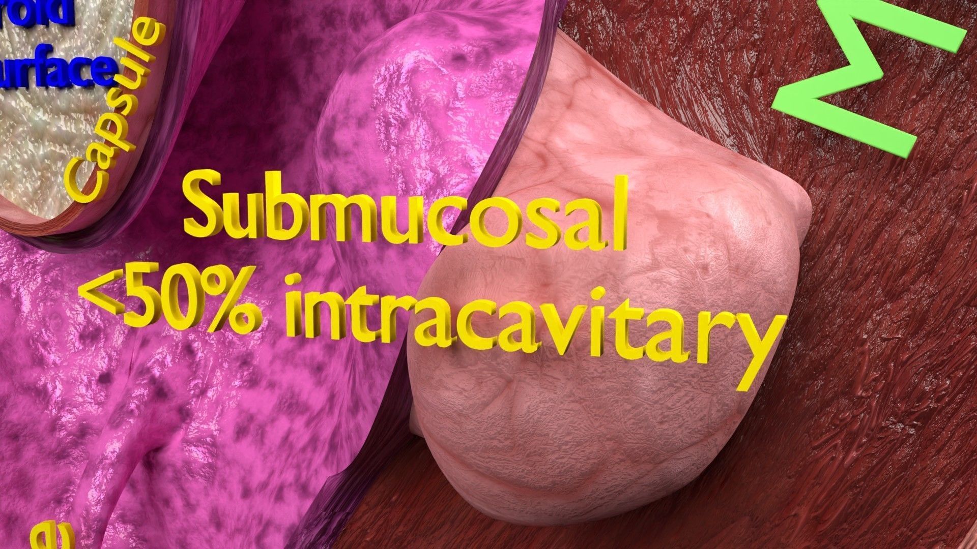 Fibroid Uterus Human female 3D Low-poly 3D model_9