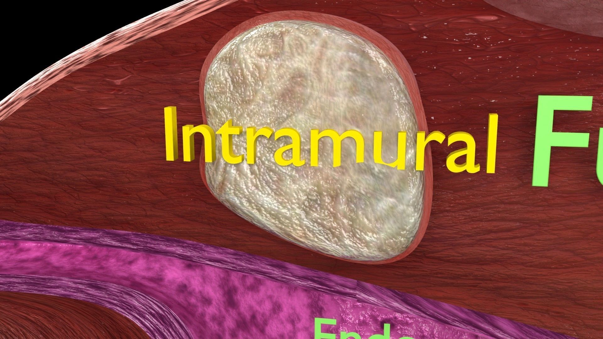 Fibroid Uterus Human female 3D Low-poly 3D model_15