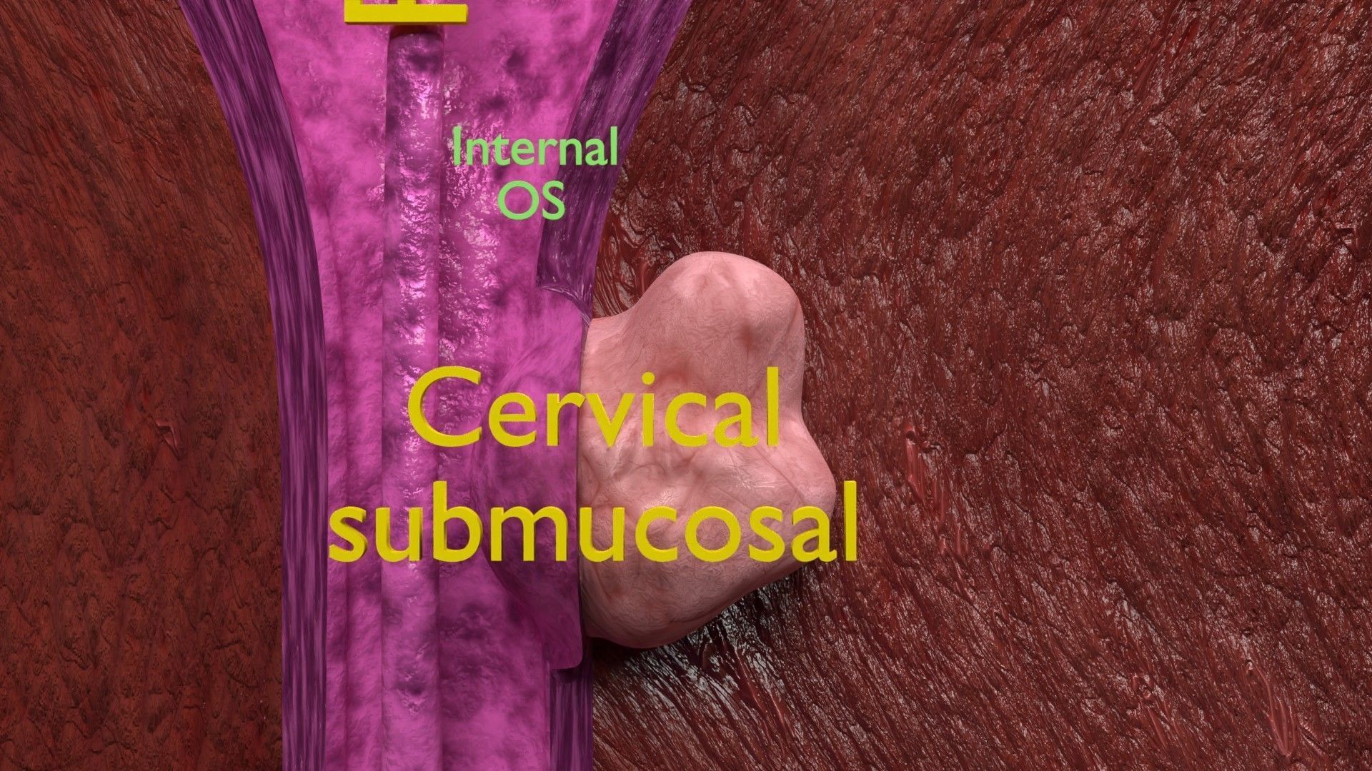 Fibroid Uterus Human female 3D Low-poly 3D model_25