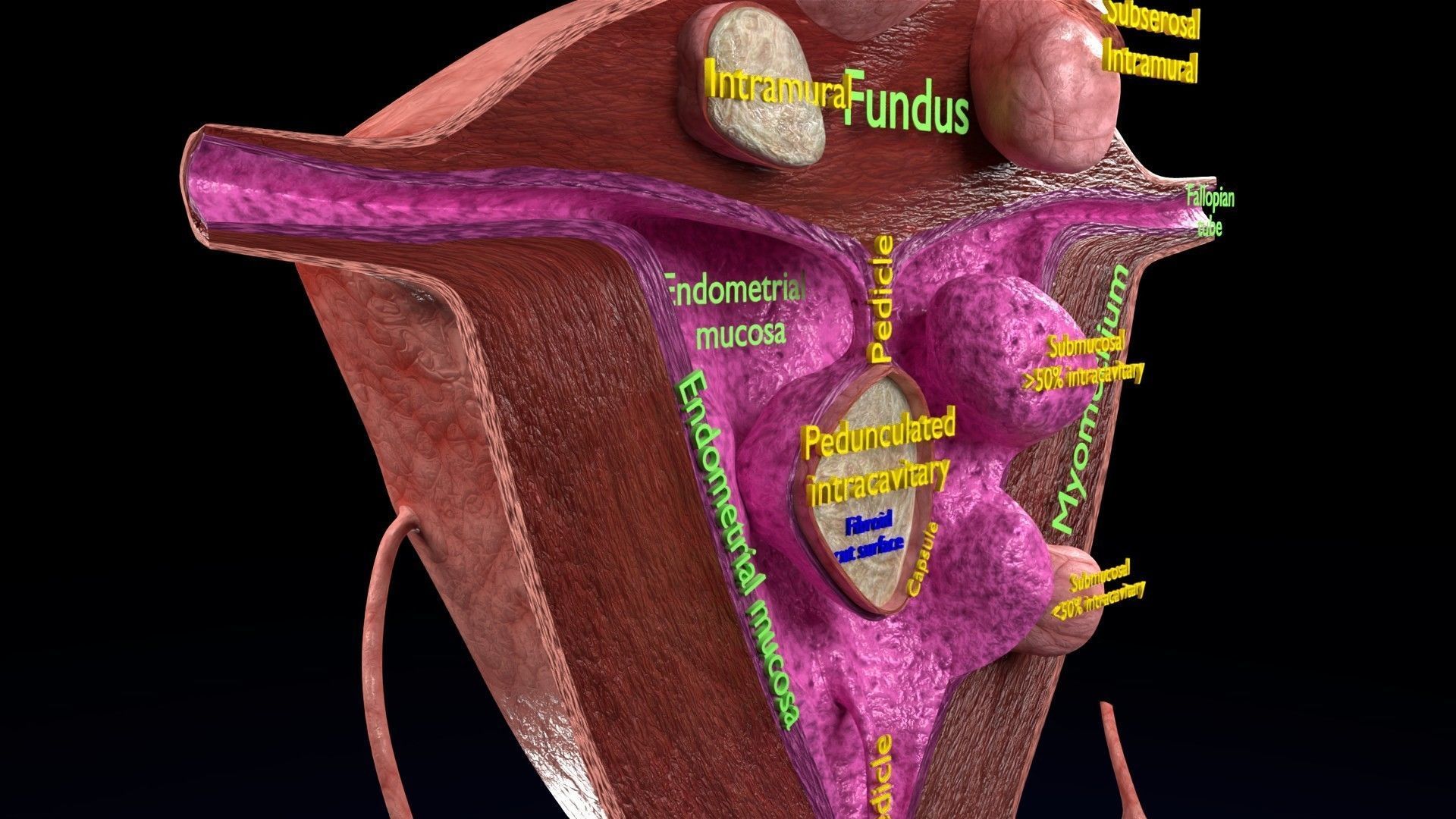 Fibroid Uterus Human female 3D Low-poly 3D model_35