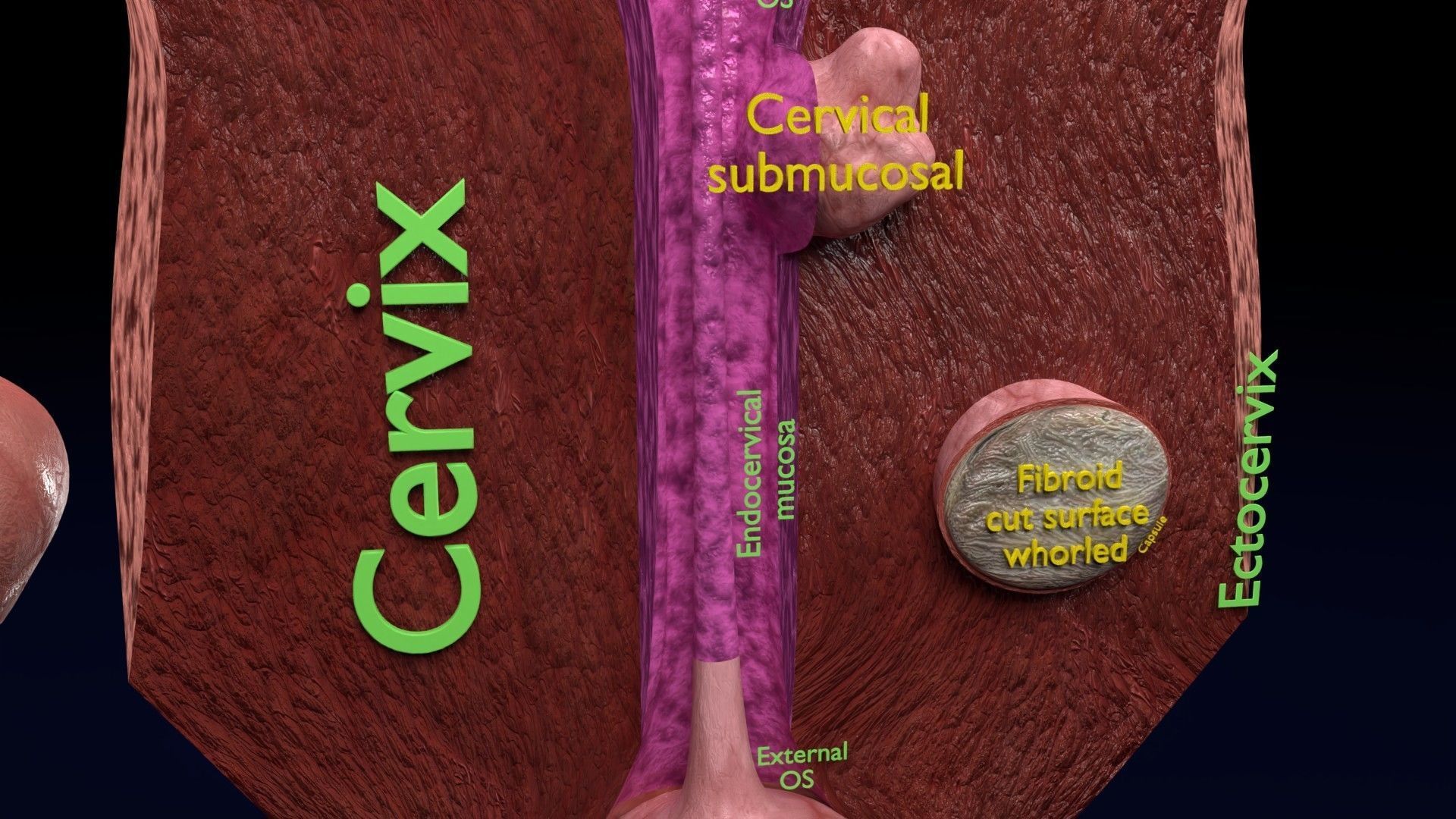 Fibroid Uterus Human female 3D Low-poly 3D model_4