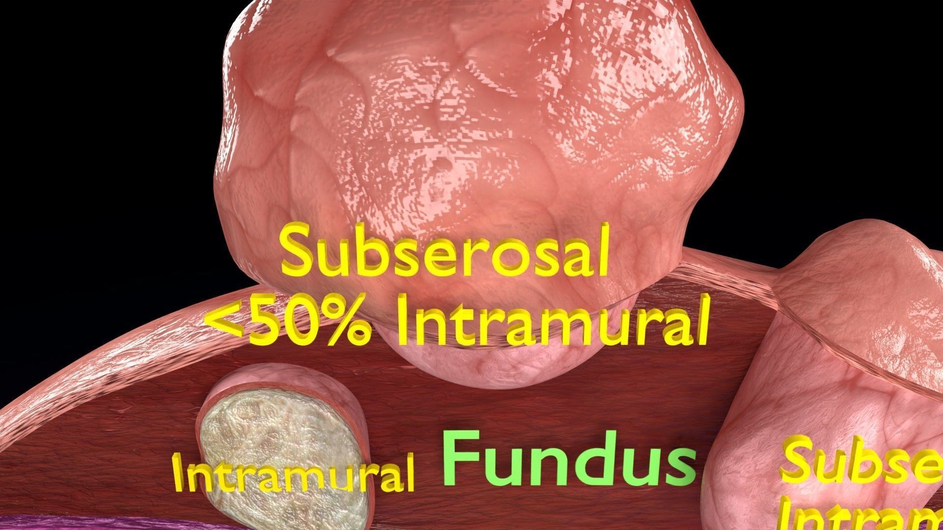 Fibroid Uterus Human female 3D Low-poly 3D model_13