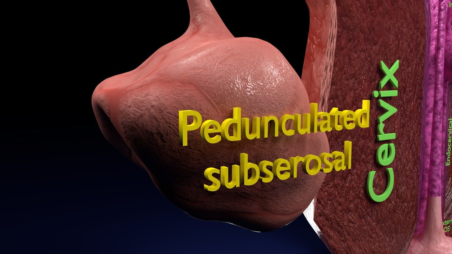 Fibroid Uterus Human female 3D Low-poly 3D model_30