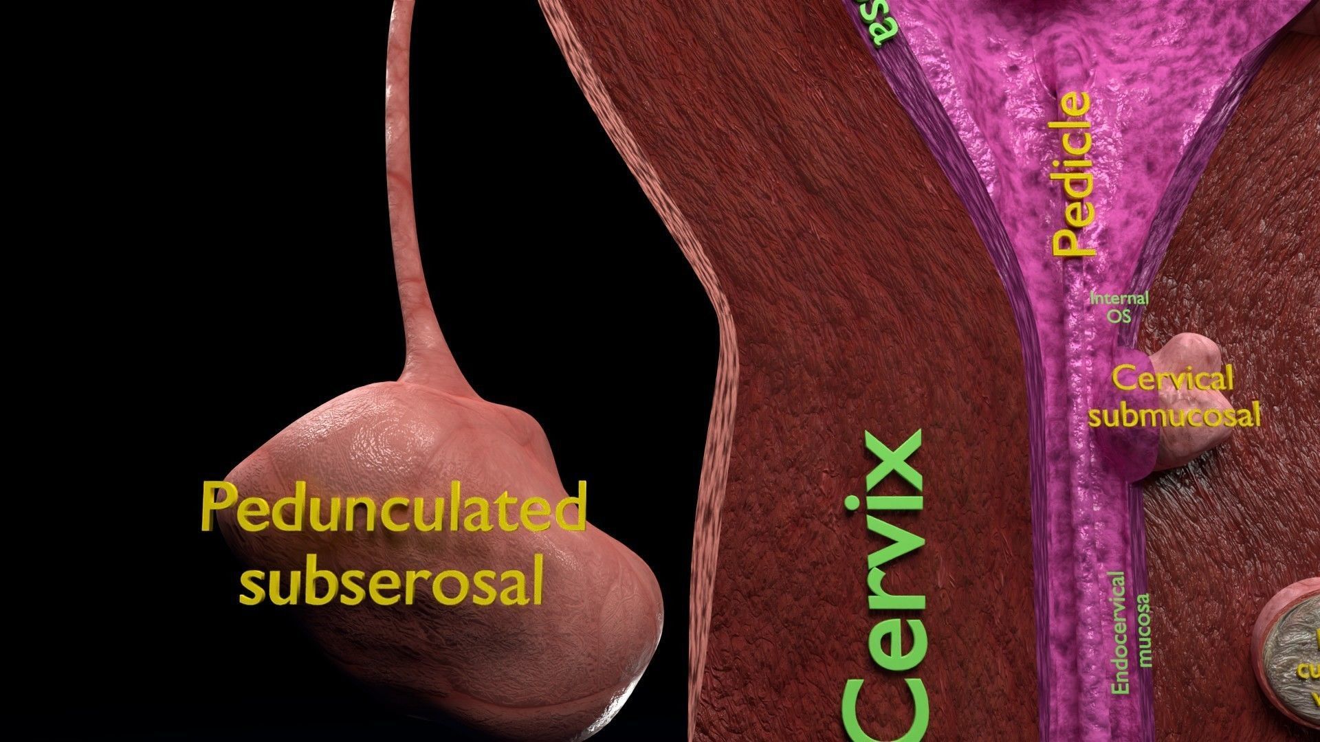 Fibroid Uterus Human female 3D Low-poly 3D model_28