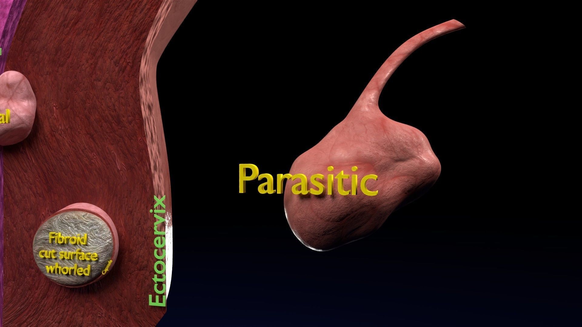 Fibroid Uterus Human female 3D Low-poly 3D model_32