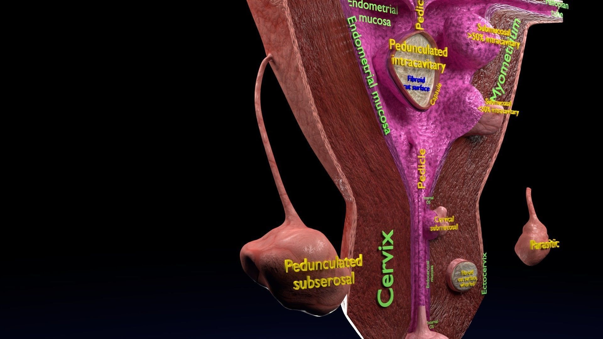 Fibroid Uterus Human female 3D Low-poly 3D model_29