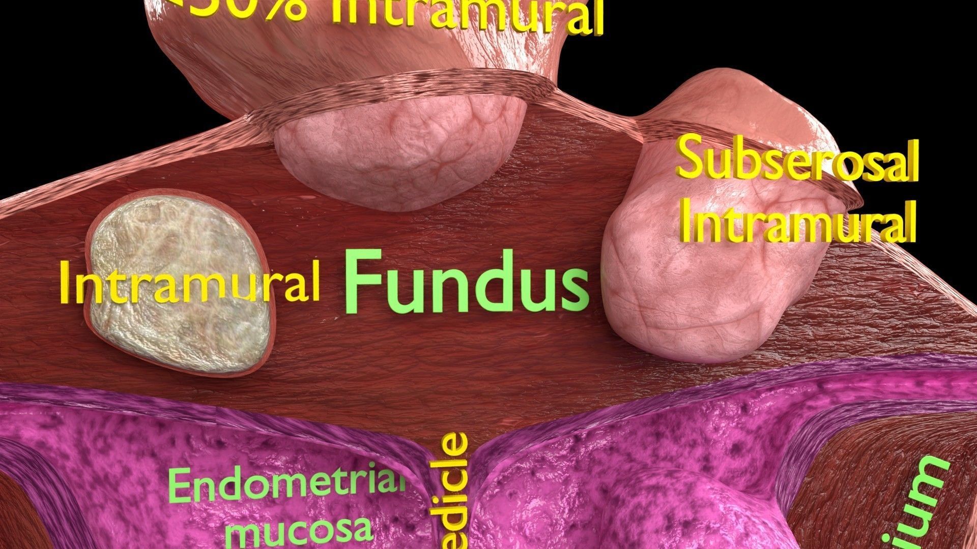 Fibroid Uterus Human female 3D Low-poly 3D model_3