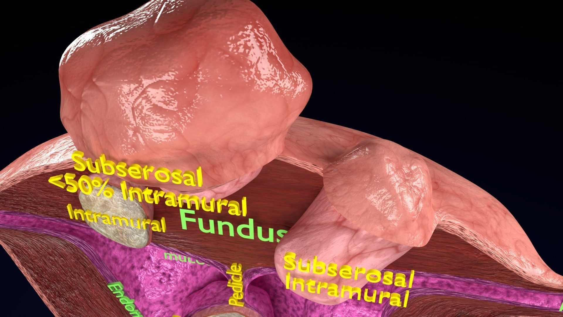 Fibroid Uterus Human female 3D Low-poly 3D model_16