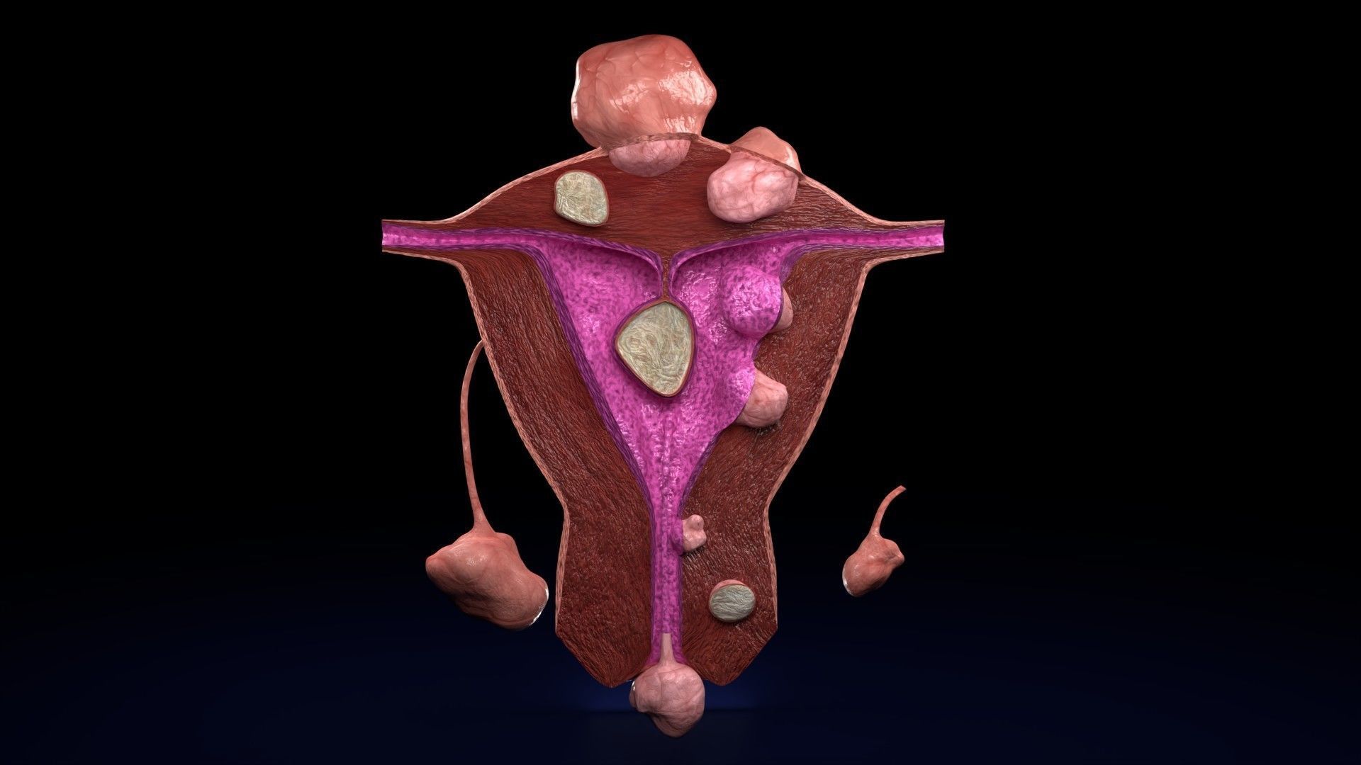 Fibroid Uterus Human female 3D Low-poly 3D model_37