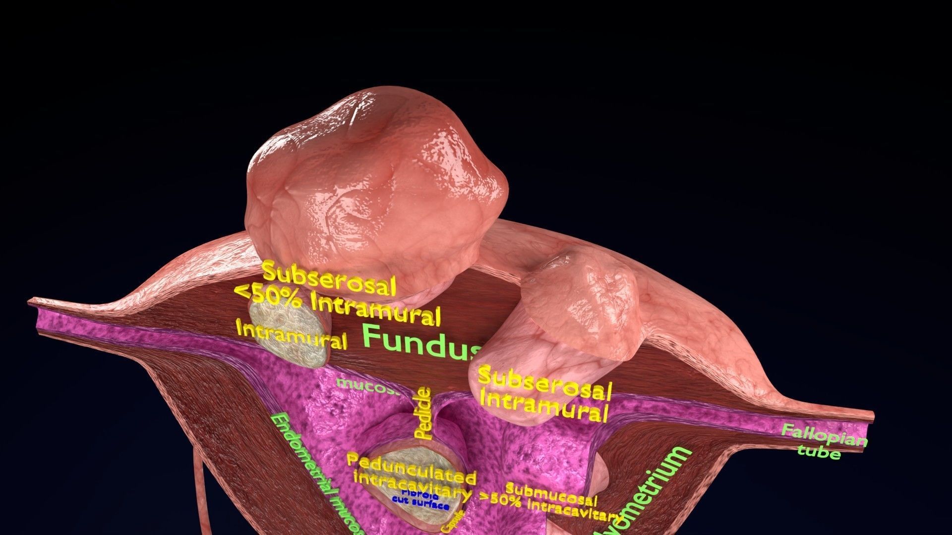 Fibroid Uterus Human female 3D Low-poly 3D model_17