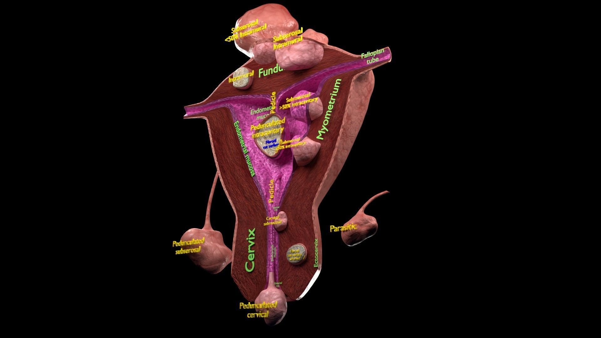 Fibroid Uterus Human female 3D Low-poly 3D model_33