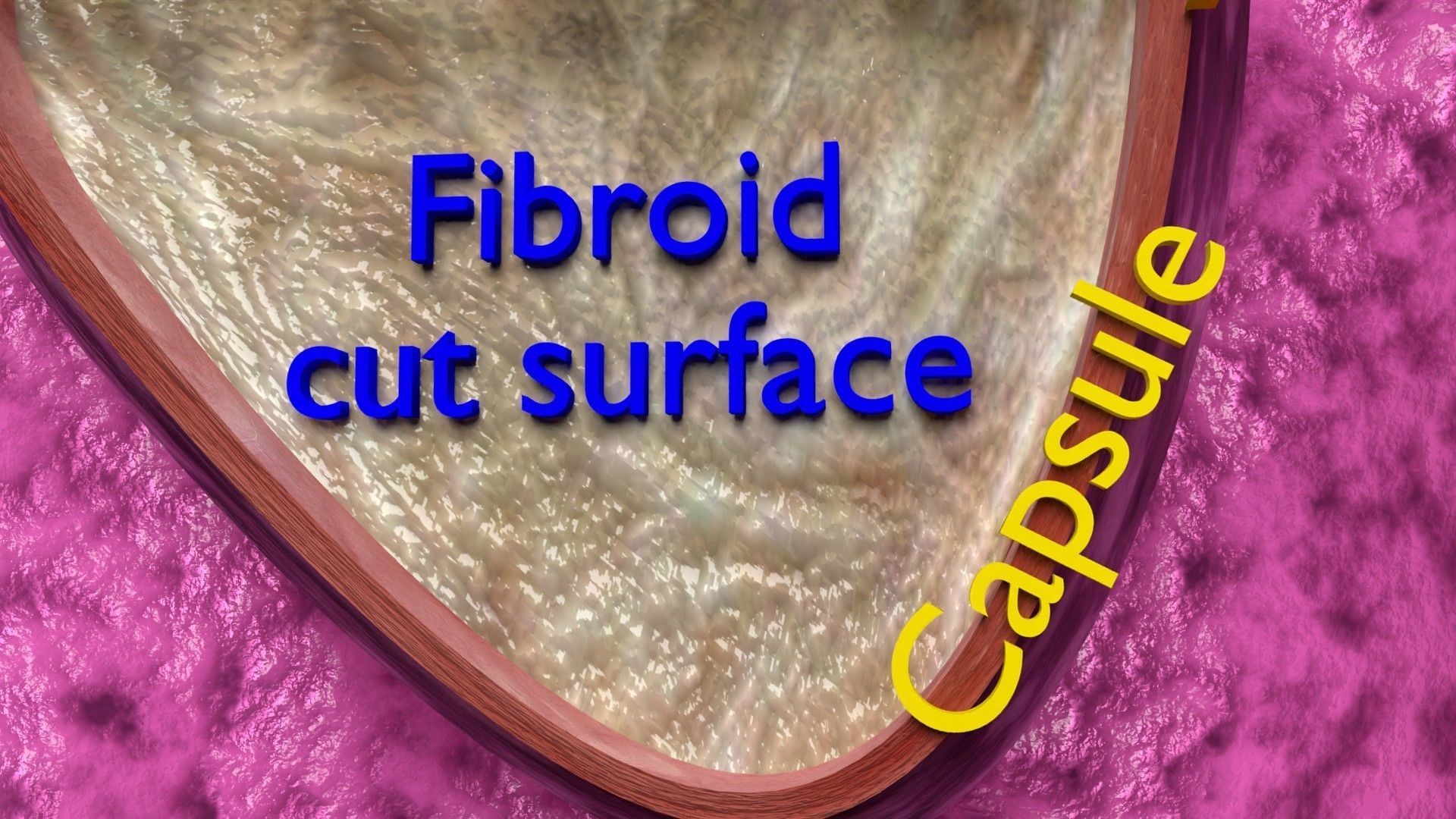 Fibroid Uterus Human female 3D Low-poly 3D model_6