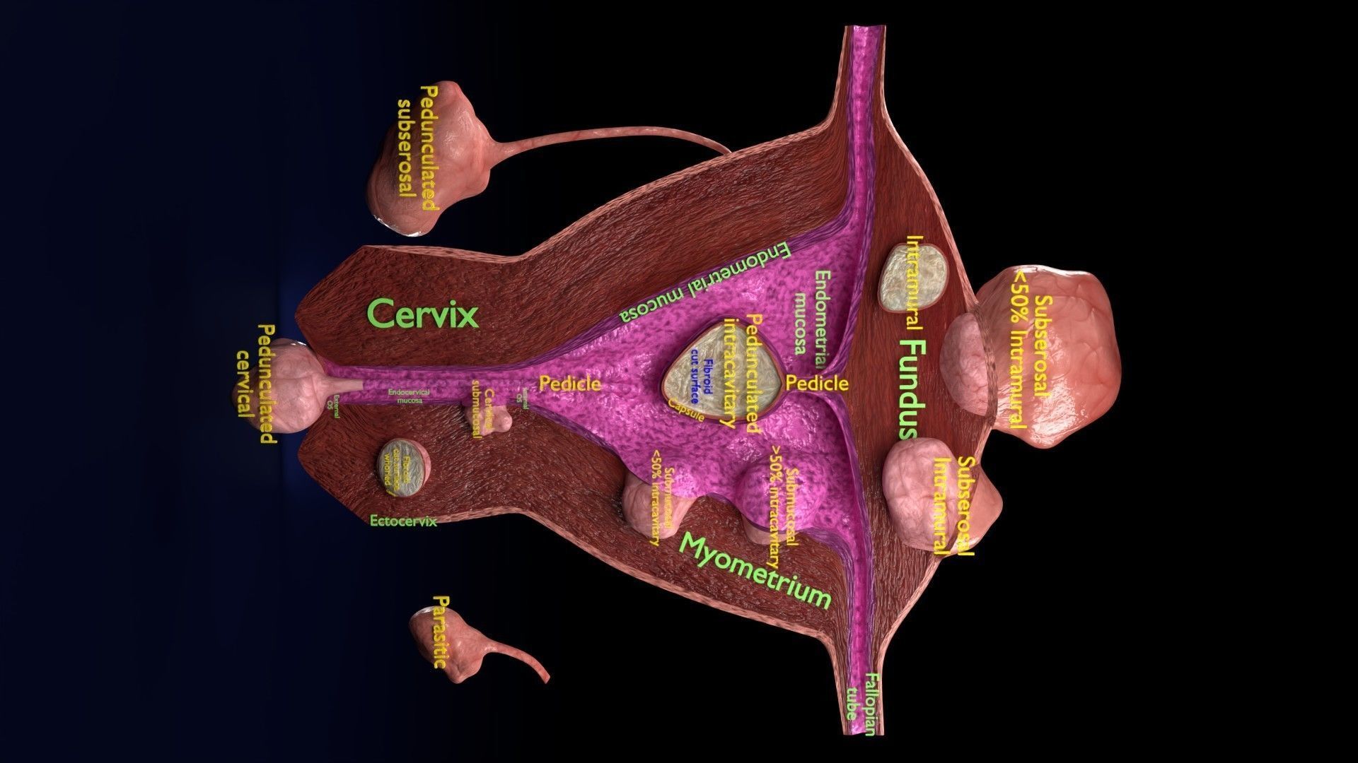 Fibroid Uterus Human female 3D Low-poly 3D model_39
